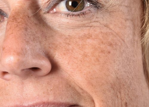 Close-up on age spots on a woman's face