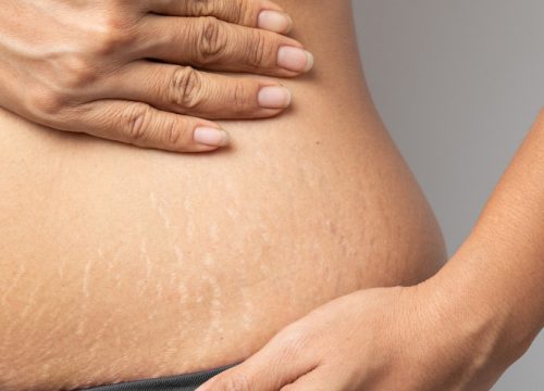 Stretch marks on a woman's side