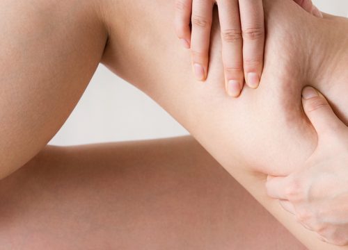 Cellulite on a woman's leg