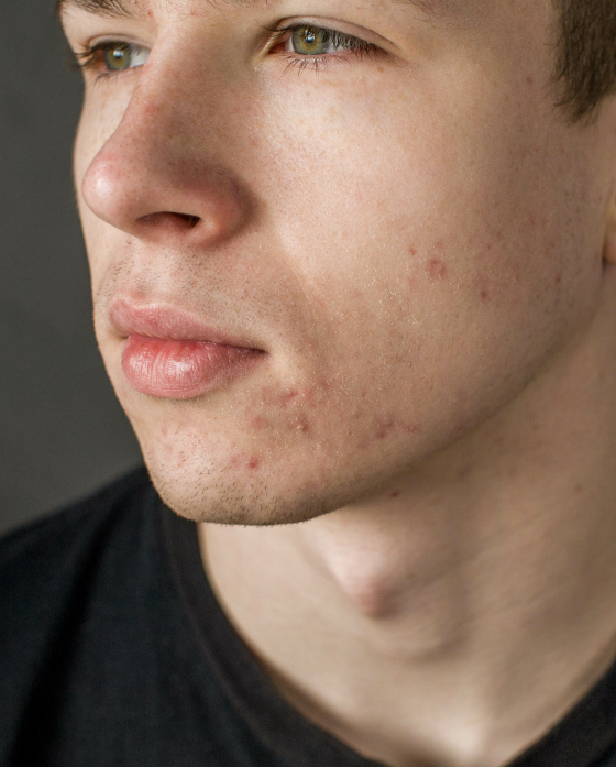 Man with acne on his chin and face