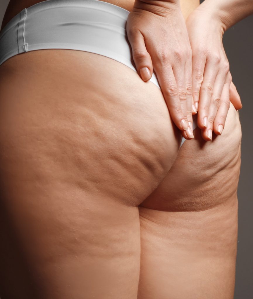 Close-up on cellulite on a woman's butt