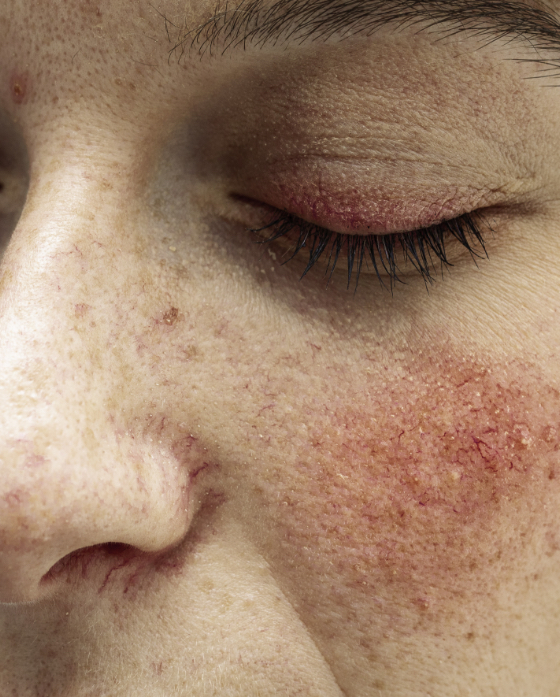 Rosacea on a woman's face