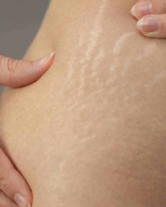 Close-up on stretch marks
