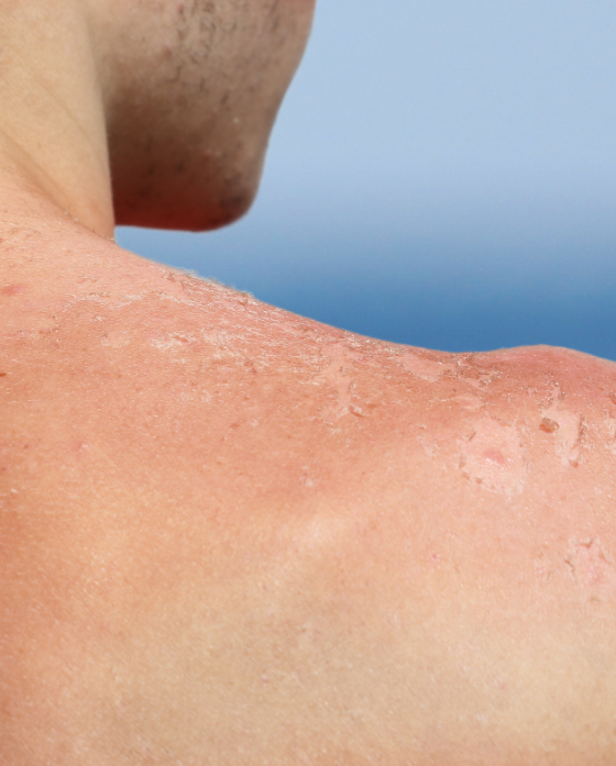 Sun damage on a man's shoulder