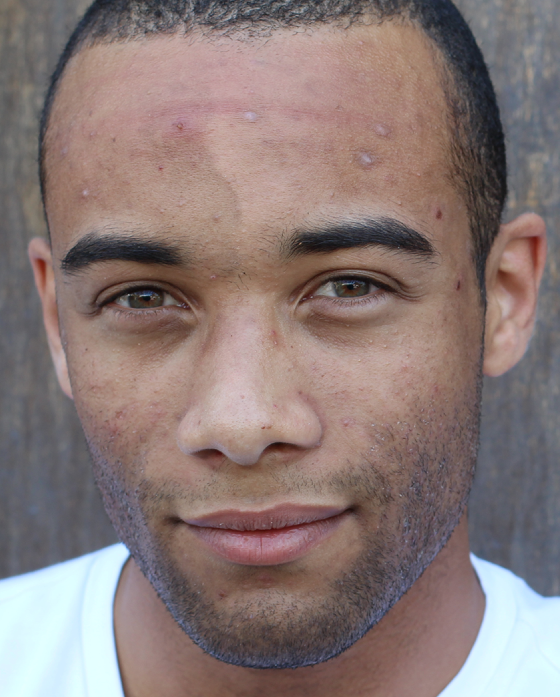 Man with scars on his face